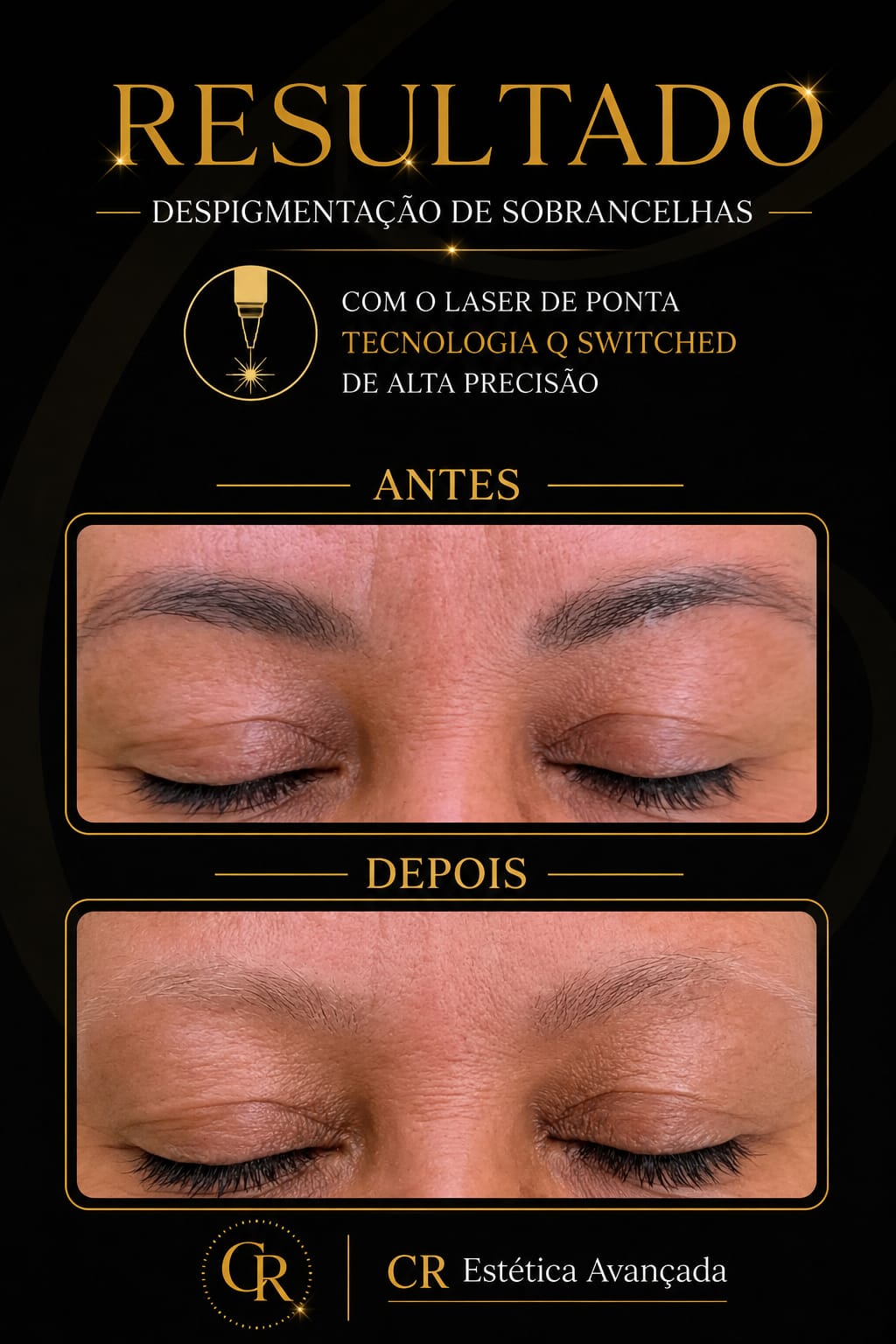 Remoção de Tatuagem