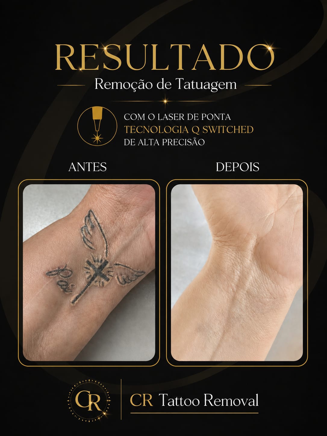 Remoção de Tatuagem